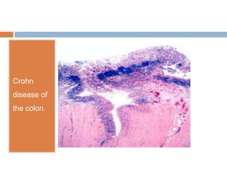 Crohn
disease of

the colon.

 