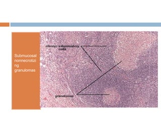 Submucosal
nonnecrotizi
ng
granulomas

 