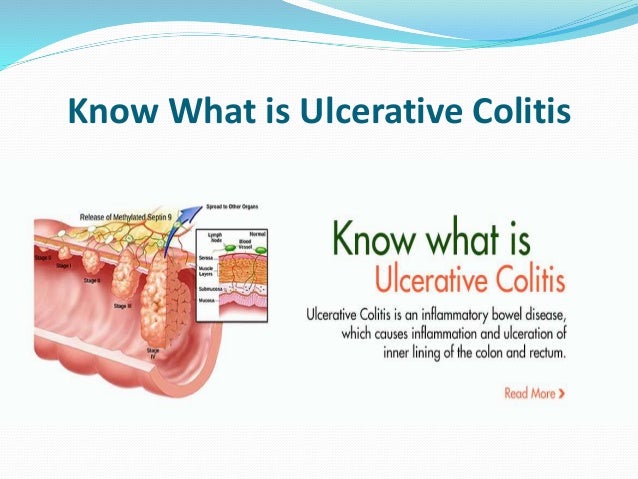 Ayurvedic Treatment for Ulcerative Colitis: Ulcerativecolitiscure