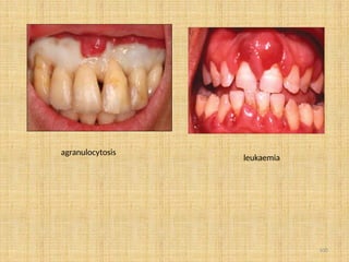 100
agranulocytosis
leukaemia
 