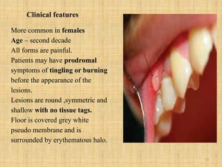 13
Clinical features
More common in females
Age – second decade
All forms are painful.
Patients may have prodromal
symptoms of tingling or burning
before the appearance of the
lesions.
Lesions are round ,symmetric and
shallow with no tissue tags.
Floor is covered grey white
pseudo membrane and is
surrounded by erythematous halo.
 