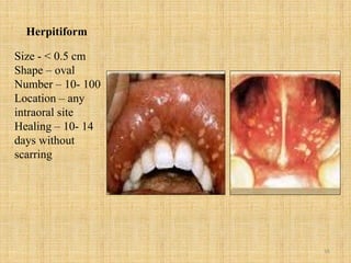 16
Herpitiform
Size - < 0.5 cm
Shape – oval
Number – 10- 100
Location – any
intraoral site
Healing – 10- 14
days without
scarring
 