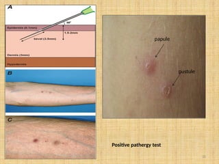 20
papule
pustule
Positive pathergy test
 
