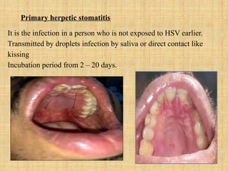 34
Primary herpetic stomatitis
It is the infection in a person who is not exposed to HSV earlier.
Transmitted by droplets infection by saliva or direct contact like
kissing
Incubation period from 2 – 20 days.
 