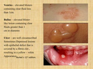 4
Vesicles – elevated blisters
containing clear fluid less
than 1cm.
Bullae – elevated blister-
like lesion containing clear
fluids greater than 1
cm in diameter.
Ulcer – are well circumscribed
Sometimes Depressed lesions
with epithelial defect that is
covered by a fibrin clot ,
resulting in a yellow – white
Appearance.
Burket`s 12th
edition.
 