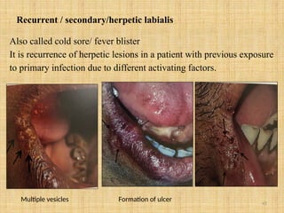 42
Recurrent / secondary/herpetic labialis
Also called cold sore/ fever blister
It is recurrence of herpetic lesions in a patient with previous exposure
to primary infection due to different activating factors.
Multiple vesicles Formation of ulcer
 