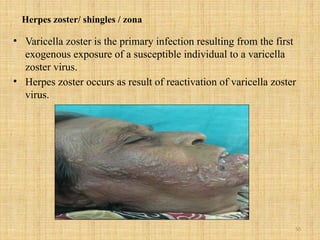 50
Herpes zoster/ shingles / zona
• Varicella zoster is the primary infection resulting from the first
exogenous exposure of a susceptible individual to a varicella
zoster virus.
• Herpes zoster occurs as result of reactivation of varicella zoster
virus.
 