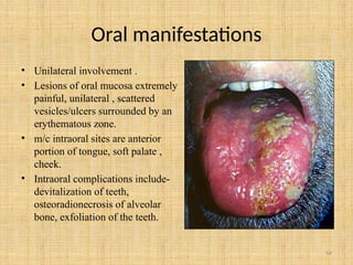 54
Oral manifestations
• Unilateral involvement .
• Lesions of oral mucosa extremely
painful, unilateral , scattered
vesicles/ulcers surrounded by an
erythematous zone.
• m/c intraoral sites are anterior
portion of tongue, soft palate ,
cheek.
• Intraoral complications include-
devitalization of teeth,
osteoradionecrosis of alveolar
bone, exfoliation of the teeth.
 