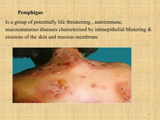 59
Pemphigus
Is a group of potentially life threatening , autoimmune,
mucocutaneous diseases charecterised by intraepithelial blistering &
erosions of the skin and mucous membrane
 