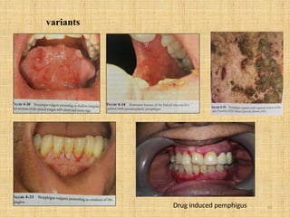 61
variants
Drug induced pemphigus
 