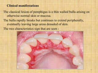 63
Clinical manifestations
The classical lesion of pemphigus is a thin walled bulla arising on
otherwise normal skin or mucosa.
The bulla rapidly breaks but continues to extend peripherally,
eventually leaving large areas denuded of skin.
The two characteristics sign that are seen -
 