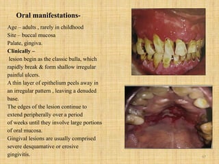 67
Oral manifestations-
Age – adults , rarely in childhood
Site – buccal mucosa
Palate, gingiva.
Clinically –
lesion begin as the classic bulla, which
rapidly break & form shallow irregular
painful ulcers.
A thin layer of epithelium peels away in
an irregular pattern , leaving a denuded
base.
The edges of the lesion continue to
extend peripherally over a period
of weeks until they involve large portions
of oral mucosa.
Gingival lesions are usually comprised
severe desquamative or erosive
gingivitis.
 