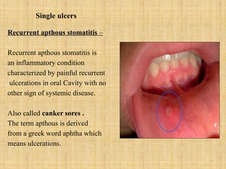 7
Single ulcers
Recurrent apthous stomatitis –
Recurrent apthous stomatitis is
an inflammatory condition
characterized by painful recurrent
ulcerations in oral Cavity with no
other sign of systemic disease.
Also called canker sores .
The term apthous is derived
from a greek word aphtha which
means ulcerations.
 