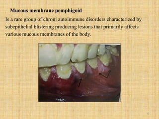72
Mucous membrane pemphigoid
Is a rare group of chroni autoimmune disorders characterized by
subepithelial blistering producing lesions that primarily affects
various mucous membranes of the body.
 