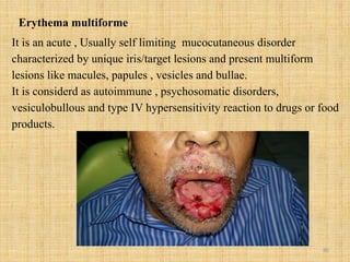 80
Erythema multiforme
It is an acute , Usually self limiting mucocutaneous disorder
characterized by unique iris/target lesions and present multiform
lesions like macules, papules , vesicles and bullae.
It is considerd as autoimmune , psychosomatic disorders,
vesiculobullous and type IV hypersensitivity reaction to drugs or food
products.
 