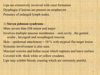 84
Lips are extensively involved with crust formation
Dysphagia if lesions are present on oropharynx
Presence of enlarged lymph nodes.
1) Steven johnson syndrome –
More severe than EM minor and major
Involves multiple mucous membranes – oral cavity , the genital ,
ocular , laryngeal and oesophageal mucosa.
Skin – epidermal attachment > 10 % with atypical flat target lesion
Systemic involvement is also seen.
Mucosal vesicles and bullae occur which ruptures and leave surface
Covered with thick white or yellow exudates.
Lips may exhibit bloody crusting which are extremely painful.
 