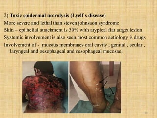 86
2) Toxic epidermal necrolysis (Lyell`s disease)
More severe and lethal than steven johnsaon syndrome
Skin – epithelial attachment is 30% with atypical flat target lesion
Systemic involvement is also seen.most common aetiology is drugs
Involvement of - mucous membranes oral cavity , genital , ocular ,
laryngeal and oesophageal and oesophageal mucosae.
 