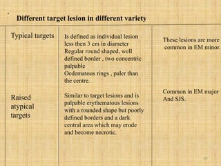 87
.
Typical targets
Raised
atypical
targets
Is defined as individual lesion
less then 3 cm in diameter
Regular round shaped, well
defined border , two concentric
palpable
Oedematous rings , paler than
the centre.
Similar to target lesions and is
palpable erythematous lesions
with a rounded shape but poorly
defined borders and a dark
central area which may erode
and become necrotic.
These lesions are more
common in EM minor.
Common in EM major
And SJS.
Different target lesion in different variety
 