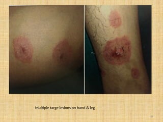 89
Multiple targe lesions on hand & leg
 