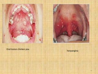 94
Oral lesion chicken pox
herpangina
 