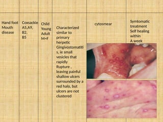 95
Hand foot
Mouth
disease
Coxsackie
A5,A9,
B2,
B5
Child
Young
Adult
M=F
Characterized
similar to
primary
herpetic
Gingivostomatiti
s, ie small
vesicles that
rapidly
Rupture ,
leaving painful
shallow ulcers
surrounded by a
red halo, but
ulcers are not
clustered
cytosmear
Symtomatic
treatment
Self healing
within
A week
 