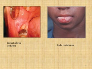 98
Contact allergic
stomatitis Cyclic neutropenia
 
