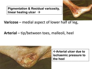 Varicose – medial aspect of lower half of leg,
Arterial – tip/between toes, malleoli, heel
Pigmentation & Residual varicosity,
linear healing ulcer 
Arterial ulcer due to
ischaemic pressure to
the heel
 