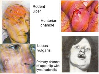 Rodent
ulcer
Lupus
vulgaris
Hunterian
chancre
Primary chancre
of upper lip with
lymphadenitis
 
