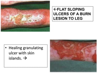 • Healing granulating
ulcer with skin
islands. 
FLAT SLOPING
ULCERS OF A BURN
LESION TO LEG
 