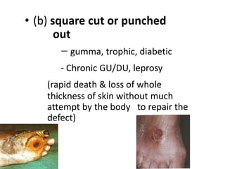 • (b) square cut or punched
out
– gumma, trophic, diabetic
- Chronic GU/DU, leprosy
(rapid death & loss of whole
thickness of skin without much
attempt by the body to repair the
defect)
 