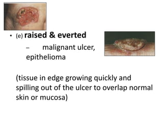 • (e) raised & everted
– malignant ulcer,
epithelioma
(tissue in edge growing quickly and
spilling out of the ulcer to overlap normal
skin or mucosa)
 