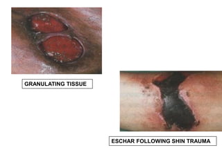 GRANULATING TISSUE
ESCHAR FOLLOWING SHIN TRAUMA
 