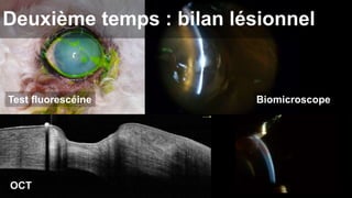 Deuxième temps : bilan lésionnel 
Test fluorescéine Biomicroscope 
OCT 
 