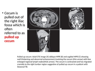 • Cecum is
pulled out of
the right iliac
fossa which is
often
referred to as
pulled up
cecum
Pulled up cecum: Axial CTE image (A) oblique MPR (B) and sagittal MPR (C) showing
wall thickening and abnormal enhancement involving the cecum (thin arrow) with few
enlarged regional lymph nodes(thick arrow). The cecum is contracted and has migrated
cranially to the right lumbar region suggestive of pulled up cecum in a patient with
ileocecal TB.
 