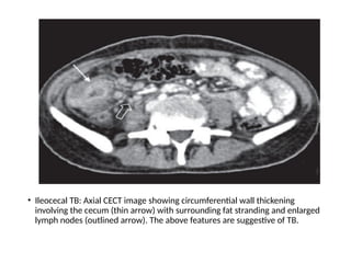 • Ileocecal TB: Axial CECT image showing circumferential wall thickening
involving the cecum (thin arrow) with surrounding fat stranding and enlarged
lymph nodes (outlined arrow). The above features are suggestive of TB.
 