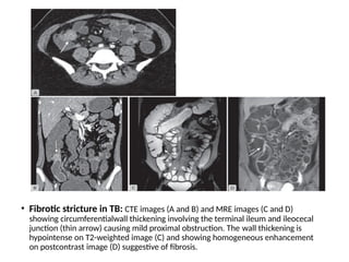 • Fibrotic stricture in TB: CTE images (A and B) and MRE images (C and D)
showing circumferentialwall thickening involving the terminal ileum and ileocecal
junction (thin arrow) causing mild proximal obstruction. The wall thickening is
hypointense on T2-weighted image (C) and showing homogeneous enhancement
on postcontrast image (D) suggestive of fibrosis.
 