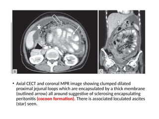 • Axial CECT and coronal MPR image showing clumped dilated
proximal jejunal loops which are encapsulated by a thick membrane
(outlined arrow) all around suggestive of sclerosing encapsulating
peritonitis (cocoon formation). There is associated loculated ascites
(star) seen.
 