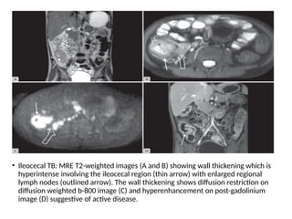 • Ileocecal TB: MRE T2-weighted images (A and B) showing wall thickening which is
hyperintense involving the ileocecal region (thin arrow) with enlarged regional
lymph nodes (outlined arrow). The wall thickening shows diffusion restriction on
diffusion weighted b-800 image (C) and hyperenhancement on post-gadolinium
image (D) suggestive of active disease.
 