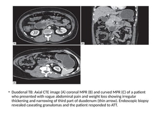 • Duodenal TB: Axial CTE image (A) coronal MPR (B) and curved MPR (C) of a patient
who presented with vague abdominal pain and weight loss showing irregular
thickening and narrowing of third part of duodenum (thin arrow). Endoscopic biopsy
revealed caseating granulomas and the patient responded to ATT.
 