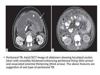 • Peritoneal TB: Axial CECT image of abdomen showing loculated ascites
(star) with smoothly thickened enhancing peritoneal lining (thin arrow)
and associated omental thickening (thick arrow). The above features are
suggestive of wet type of peritoneal TB.
 