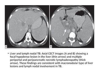 • Liver and lymph nodal TB: Axial CECT images (A and B) showing a
focal hypodense lesion in the liver (thin arrow) and multiple
periportal and peripancreatic necrotic lymphadenopathy (thick
arrow). These findings are consistent with macronodular type of liver
lesions and lymph nodal involvement in TB.
 
