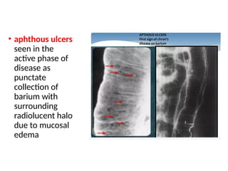 • aphthous ulcers
seen in the
active phase of
disease as
punctate
collection of
barium with
surrounding
radiolucent halo
due to mucosal
edema
 