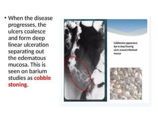• When the disease
progresses, the
ulcers coalesce
and form deep
linear ulceration
separating out
the edematous
mucosa. This is
seen on barium
studies as cobble
stoning.
 
