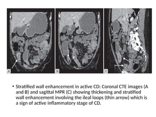 • Stratified wall enhancement in active CD: Coronal CTE images (A
and B) and sagittal MPR (C) showing thickening and stratified
wall enhancement involving the ileal loops (thin arrow) which is
a sign of active inflammatory stage of CD.
 