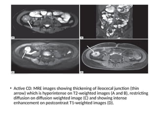 • Active CD: MRE images showing thickening of ileocecal junction (thin
arrow) which is hyperintense on T2-weighted images (A and B), restricting
diffusion on diffusion weighted image (C) and showing intense
enhancement on postcontrast T1-weighted images (D).
 