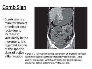 Comb Sign
• Comb sign is a
manifestation of
prominent vasa
recta due to
increase in
vascularity in the
mesentery. It is
regarded as one
of the specific
signs of active
inflammation
Coronal CTE image showing a segment of dilated ileal loop
with increasedmesenteric vascularity (comb sign) (thin
arrow) in a patient with CD. Presence of comb sign is a
marker of active inflammatory stage of CD.
 