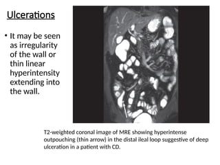 Ulcerations
• It may be seen
as irregularity
of the wall or
thin linear
hyperintensity
extending into
the wall.
T2-weighted coronal image of MRE showing hyperintense
outpouching (thin arrow) in the distal ileal loop suggestive of deep
ulceration in a patient with CD.
 