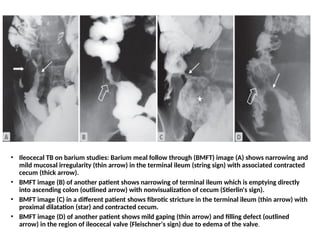 • Ileocecal TB on barium studies: Barium meal follow through (BMFT) image (A) shows narrowing and
mild mucosal irregularity (thin arrow) in the terminal ileum (string sign) with associated contracted
cecum (thick arrow).
• BMFT image (B) of another patient shows narrowing of terminal ileum which is emptying directly
into ascending colon (outlined arrow) with nonvisualization of cecum (Stierlin's sign).
• BMFT image (C) in a different patient shows fibrotic stricture in the terminal ileum (thin arrow) with
proximal dilatation (star) and contracted cecum.
• BMFT image (D) of another patient shows mild gaping (thin arrow) and filling defect (outlined
arrow) in the region of ileocecal valve (Fleischner's sign) due to edema of the valve.
 