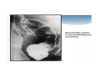 Ulceroconstrictive ds of gitdyuyfuutf.pptx
