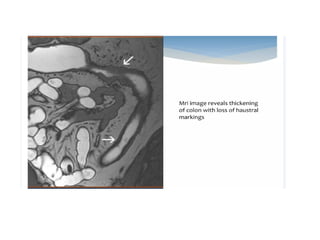 Ulceroconstrictive ds of gitdyuyfuutf.pptx